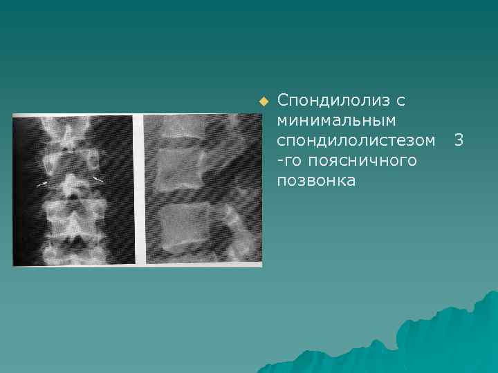 u Спондилолиз с минимальным спондилолистезом 3 -го поясничного позвонка 