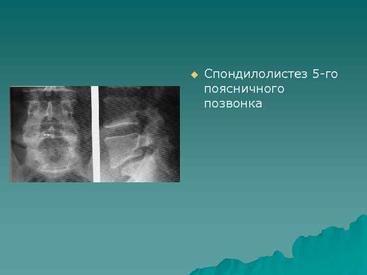 u Спондилолистез 5 -го поясничного позвонка 