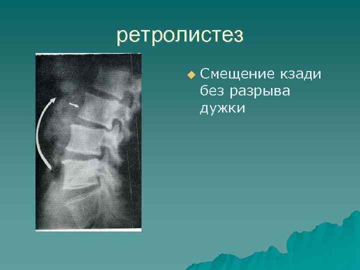 ретролистез u Смещение кзади без разрыва дужки 