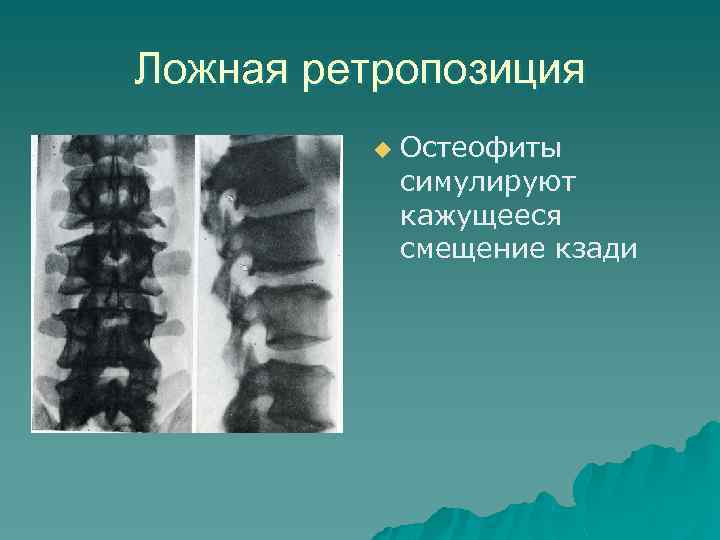 Ложная ретропозиция u Остеофиты симулируют кажущееся смещение кзади 