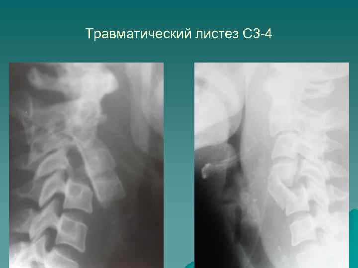 Травматический листез С 3 -4 