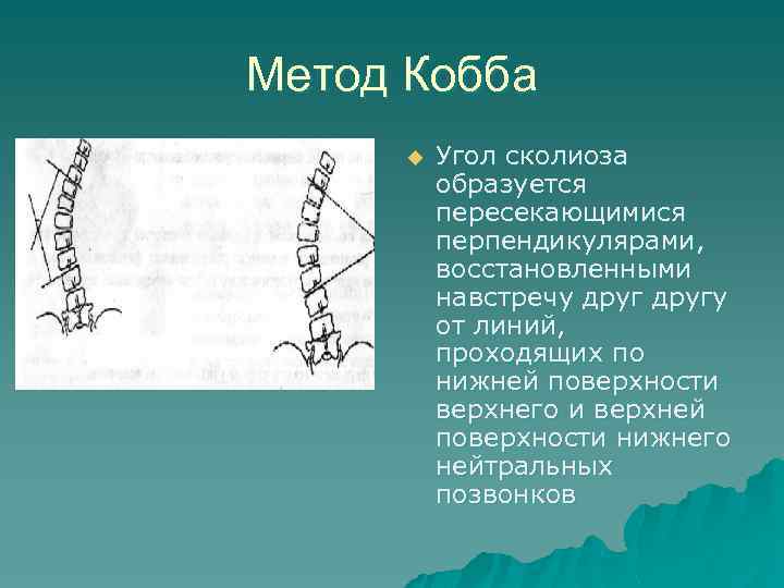 Метод Кобба u Угол сколиоза образуется пересекающимися перпендикулярами, восстановленными навстречу другу от линий, проходящих