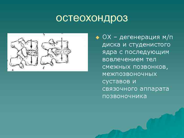 остеохондроз u ОХ – дегенерация м/п диска и студенистого ядра с последующим вовлечением тел