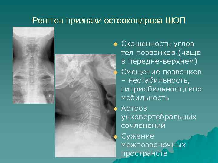 Рентген признаки остеохондроза ШОП u u Скошенность углов тел позвонков (чаще в передне-верхнем) Смещение