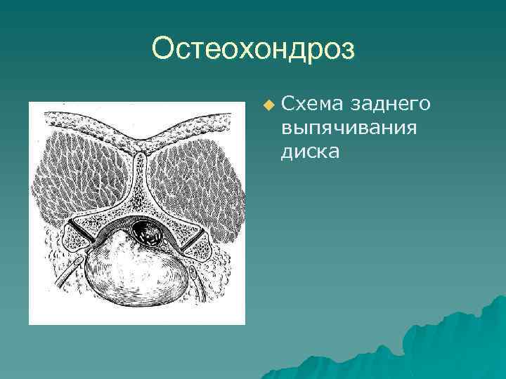 Остеохондроз u Схема заднего выпячивания диска 