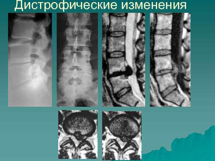 Дистрофические изменения 