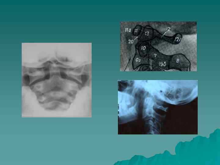 Рентгеноанатомия поясничного отдела позвоночного столба