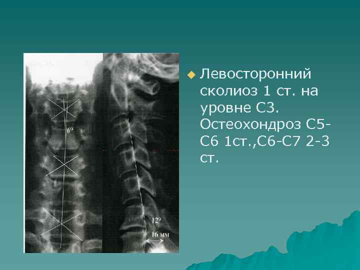 u Левосторонний сколиоз 1 ст. на уровне С 3. Остеохондроз С 5 С 6