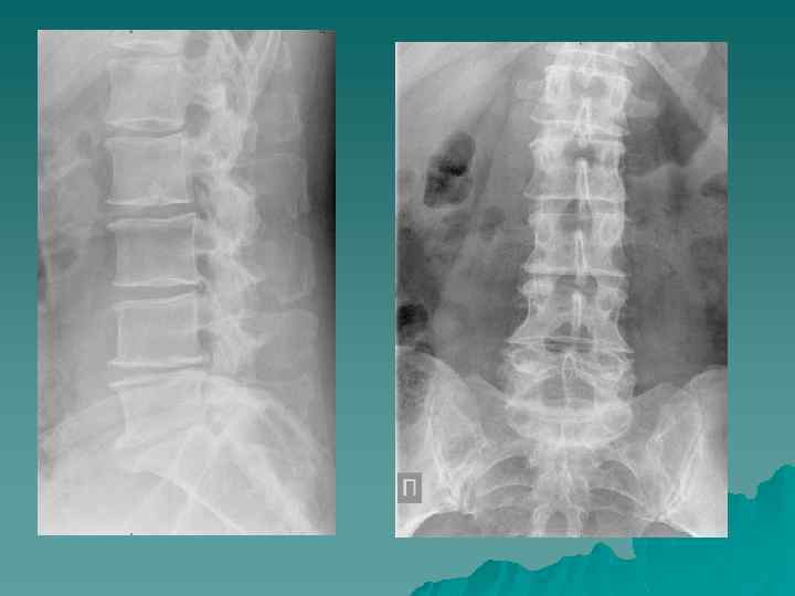 Рентгенанатомия поясничного отдела позвоночника
