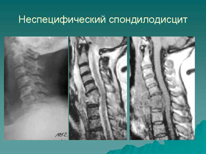 Рентген или компьютерная томография позвоночника