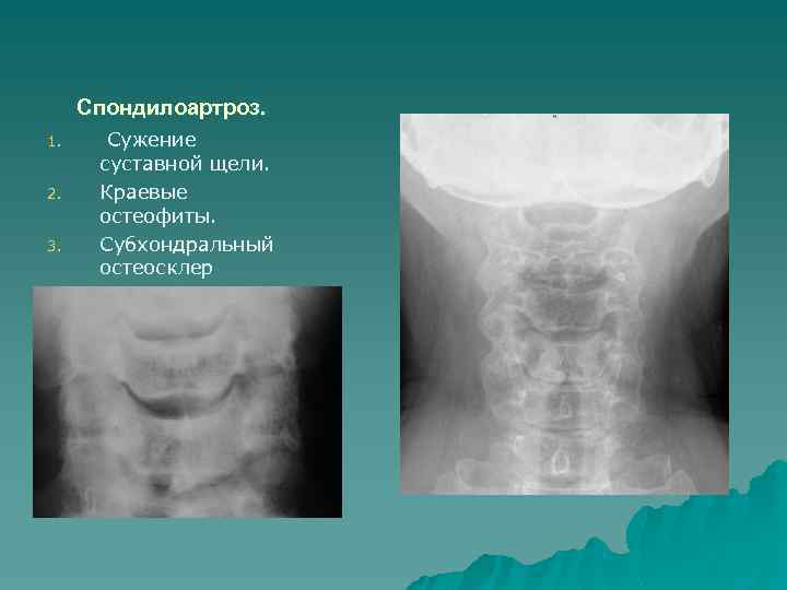 Спондилоартроз шейного отдела