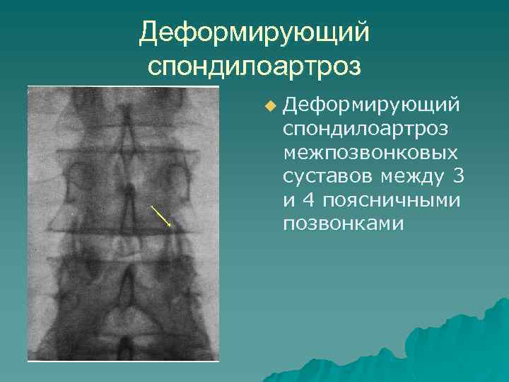 Спондилоартроз. Спондилез поясничного отдела рентген. Спондилоартроз поясничного отдела рентген. Деформирующий спондилоартроз рентген. Деформирующий спондилоартроз позвоночника.