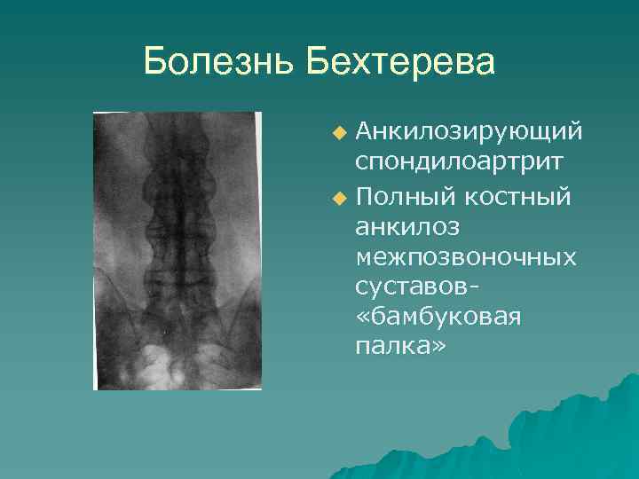 Болезнь Бехтерева Анкилозирующий спондилоартрит u Полный костный анкилоз межпозвоночных суставов- «бамбуковая палка» u 