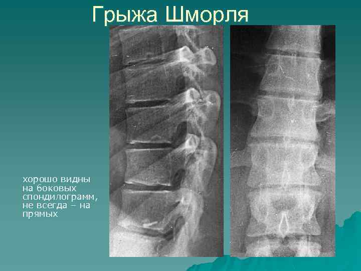 Грыжа Шморля хорошо видны на боковых спондилограмм, не всегда – на прямых 