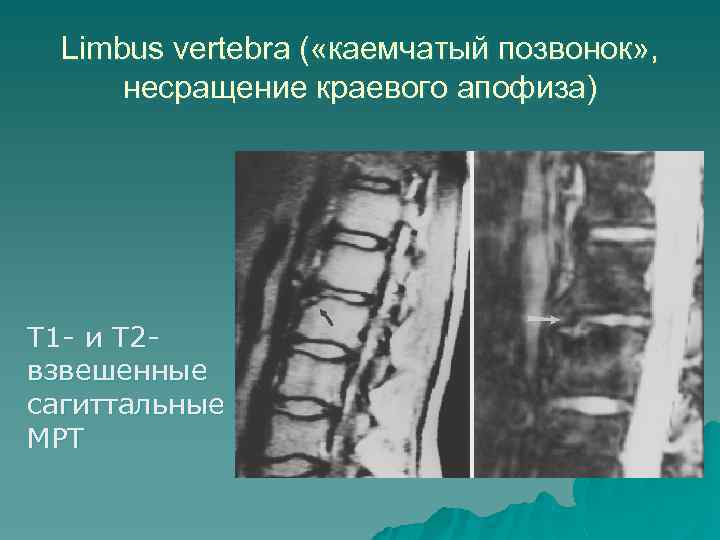 Limbus vertebra ( «каемчатый позвонок» , несращение краевого апофиза) T 1 - и Т