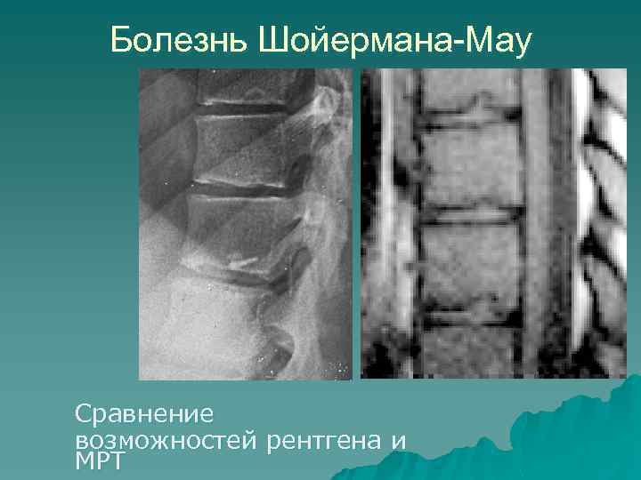 Болезнь Шойермана-Мау Сравнение возможностей рентгена и МРТ 