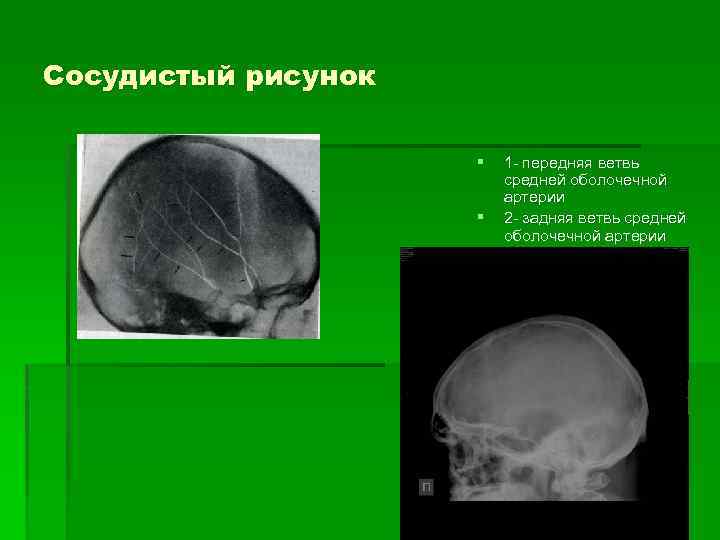 Усилен рисунок пальцевых вдавлений по всему своду черепа у ребенка