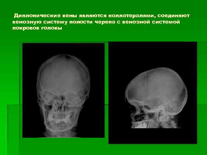 Рентген черепа в 2 х проекциях. Вены черепа рентген анатомия. Лучевая анатомия черепа. Полость черепа по Симпсону. Вены выпускники анатомия рентген.