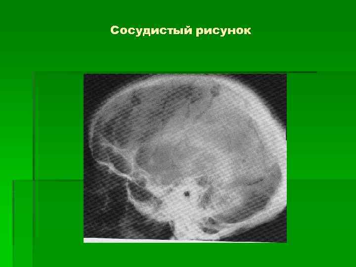 Усиление сосудистого рисунка черепа что значит