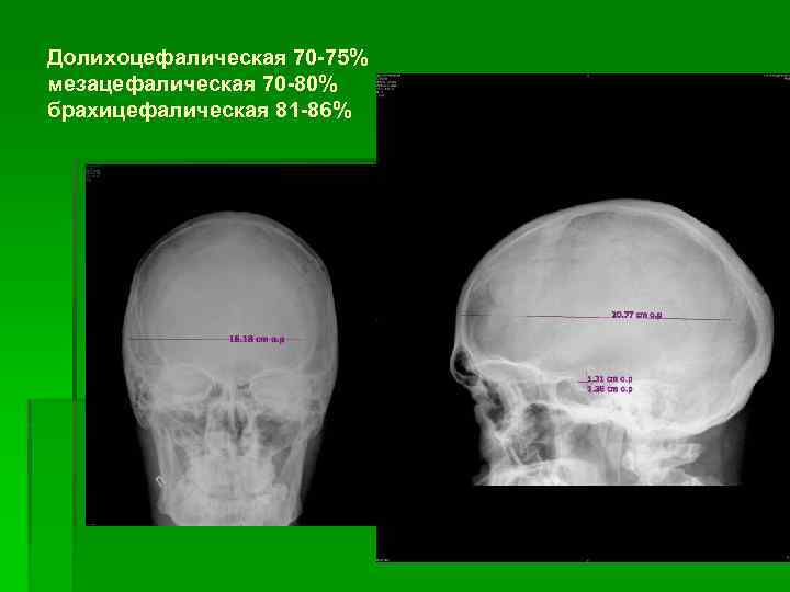 Долихоцефалическая 70 -75% мезацефалическая 70 -80% брахицефалическая 81 -86% 