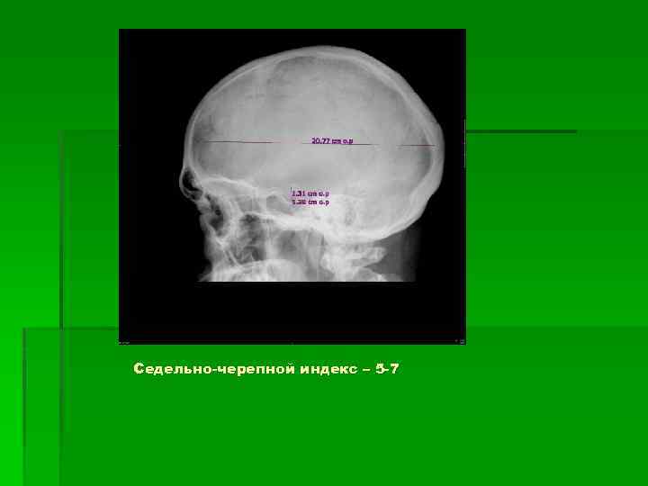 Седельно-черепной индекс – 5 -7 