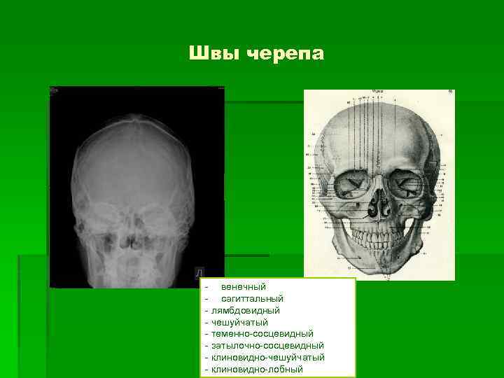 Швы черепа - венечный - сагиттальный - лямбдовидный - чешуйчатый - теменно-сосцевидный - затылочно-сосцевидный