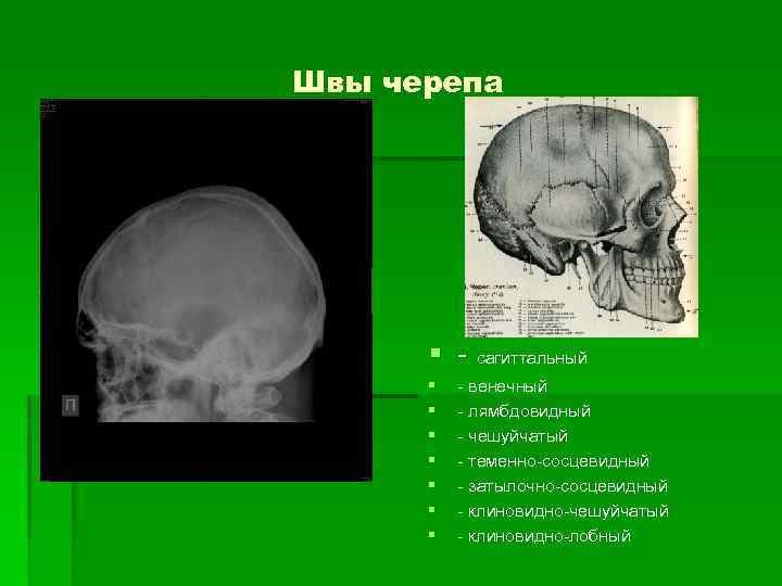 Швы черепа § - сагиттальный § § § § - венечный - лямбдовидный -