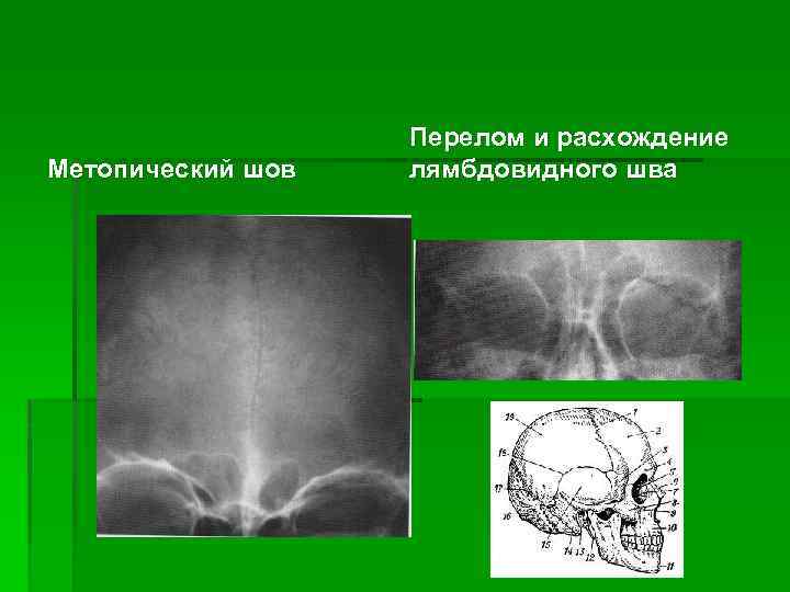 Рентген черепа в 2 х проекциях