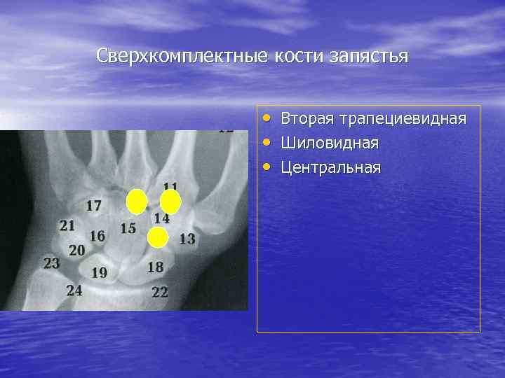 Сверхкомплектные кости запястья • Вторая трапециевидная • Шиловидная • Центральная 