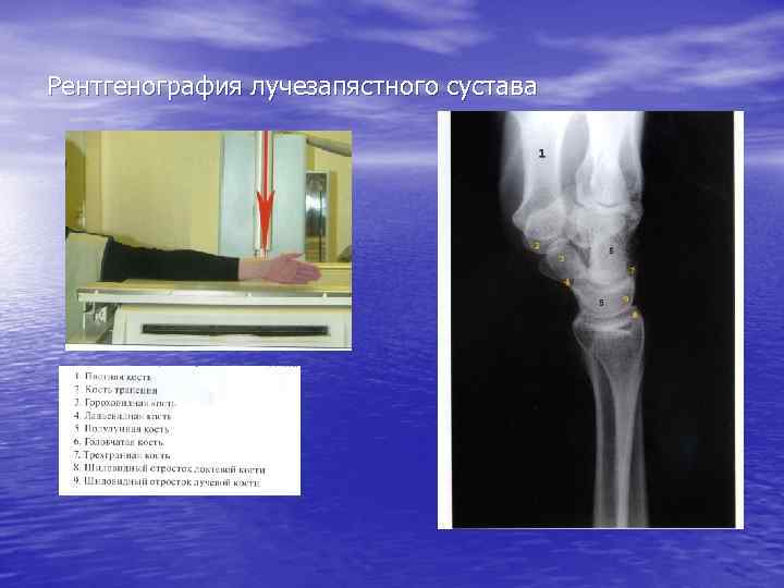 Рентгенография лучезапястного сустава 
