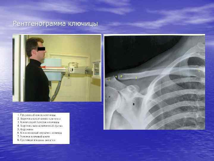 Рентгенограмма ключицы 