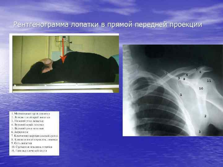 Рентгенограмма лопатки в прямой передней проекции 