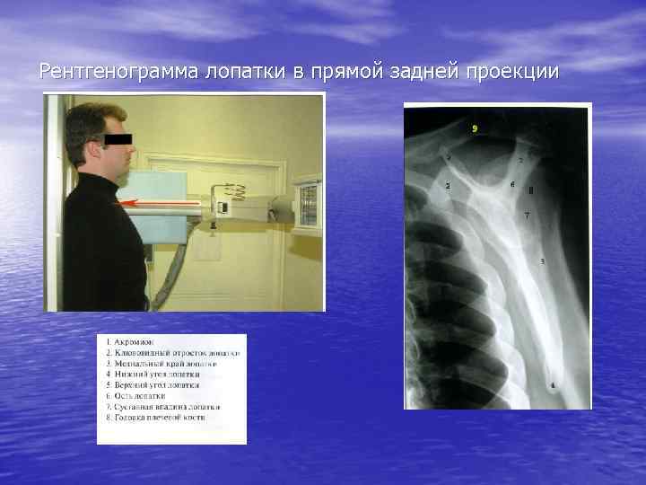 Рентгенограмма лопатки в прямой задней проекции 