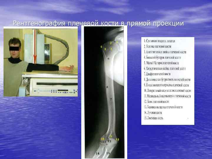 Рентгенография плечевой кости в прямой проекции 