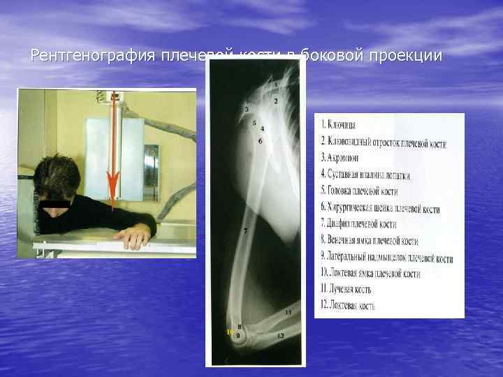 Рентгенография плечевой кости в боковой проекции 