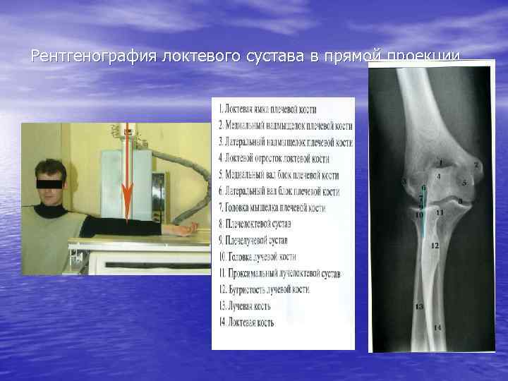 Рентгенография локтевого сустава в прямой проекции 