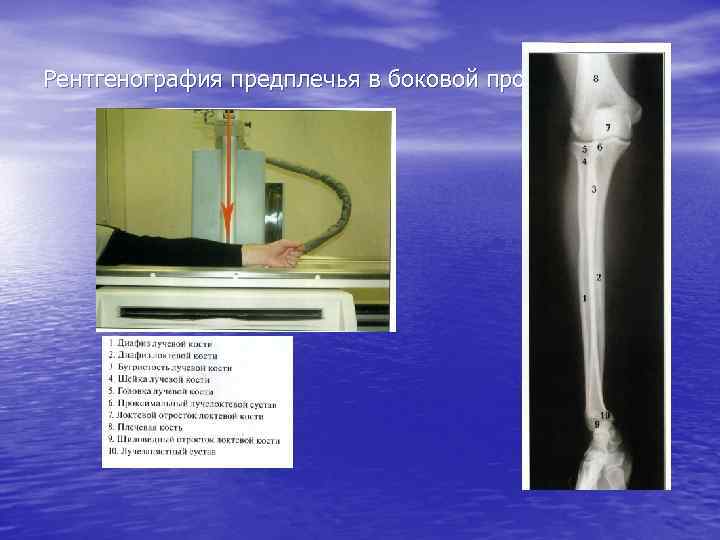 Рентгенография предплечья в боковой проекции 