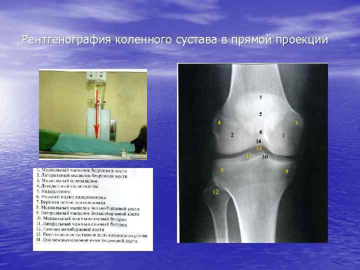 Рентгенография коленного сустава в прямой проекции 