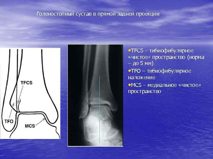 Добавочные кости голеностопного сустава схема