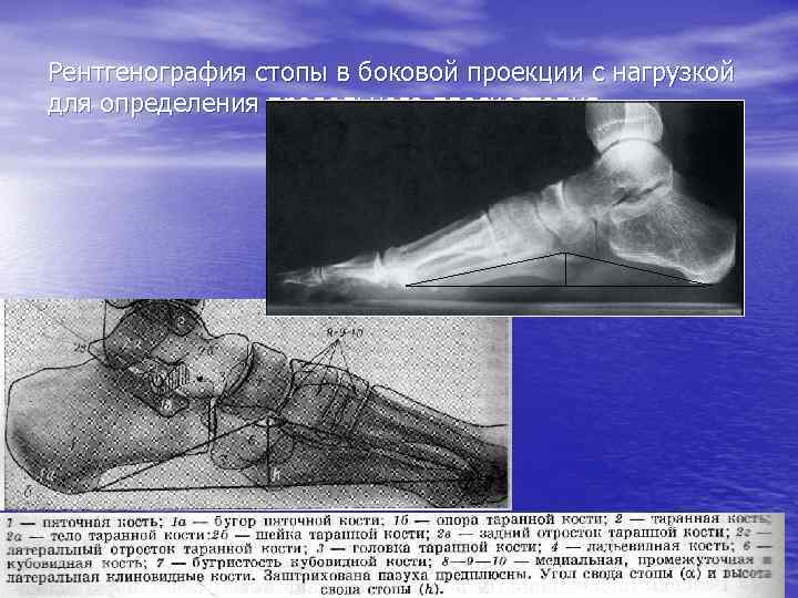 Рентгенография стопы в боковой проекции с нагрузкой для определения продольного плоскостопия 