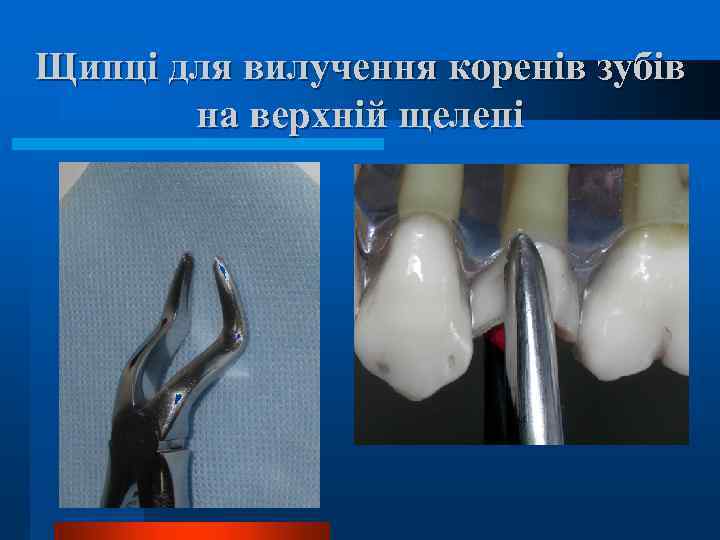 Щипці для вилучення коренів зубів на верхній щелепі 