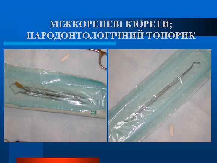 МІЖКОРЕНЕВІ КЮРЕТИ; ПАРОДОНТОЛОГІЧНИЙ ТОПОРИК 