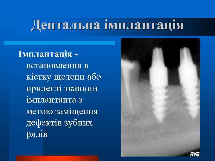 Дентальна імплантація Імплантація встановлення в кістку щелепи або прилеглі тканини імплантанта з метою заміщення