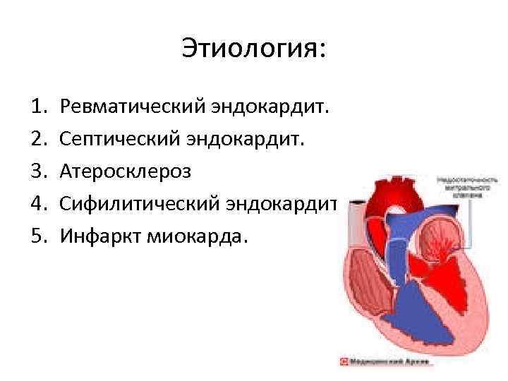 Этиология: 1. 2. 3. 4. 5. Ревматический эндокардит. Септический эндокардит. Атеросклероз Сифилитический эндокардит Инфаркт