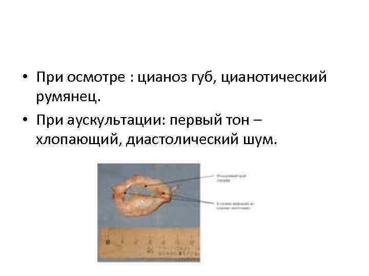  • При осмотре : цианоз губ, цианотический румянец. • При аускультации: первый тон