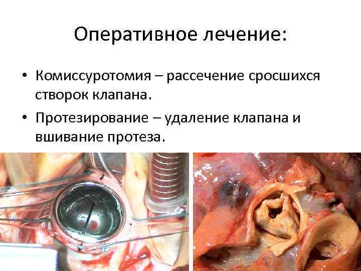 Оперативное лечение: • Комиссуротомия – рассечение сросшихся створок клапана. • Протезирование – удаление клапана