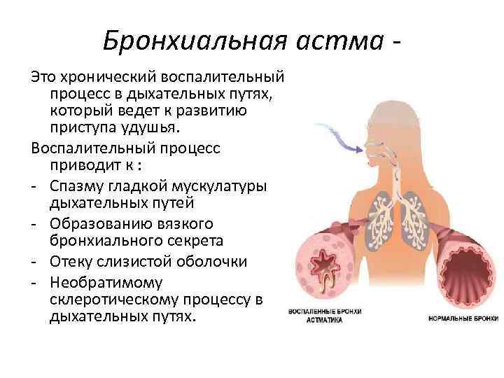 Бронхиальная астма Это хронический воспалительный процесс в дыхательных путях, который ведет к развитию приступа