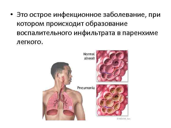  • Это острое инфекционное заболевание, при котором происходит образование воспалительного инфильтрата в паренхиме