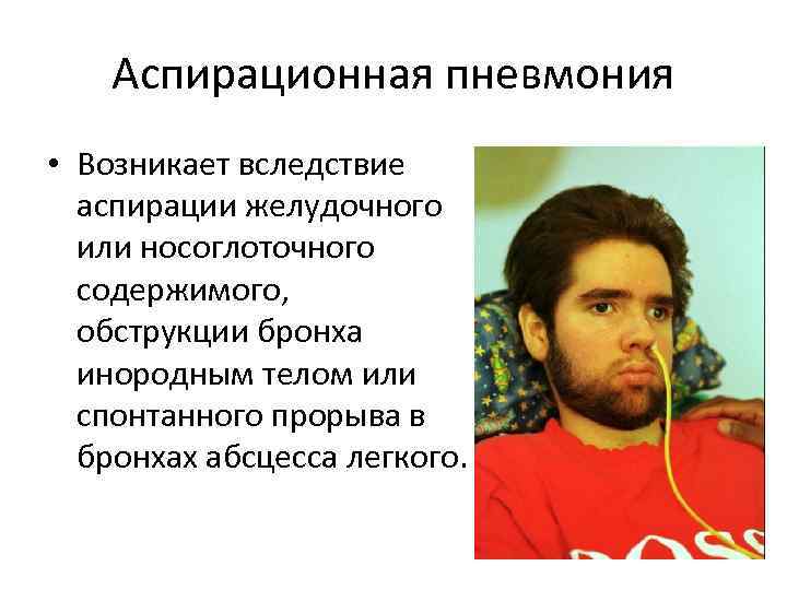 Аспирационная пневмония • Возникает вследствие аспирации желудочного или носоглоточного содержимого, обструкции бронха инородным телом