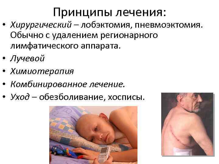 Принципы лечения: • Хирургический – лобэктомия, пневмоэктомия. Обычно с удалением регионарного лимфатического аппарата. •